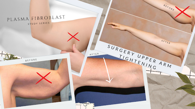 Upper arm surgery