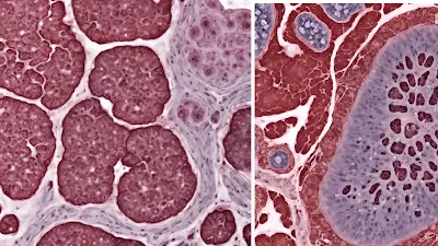 Benign cystic mesothelioma pathology outlines