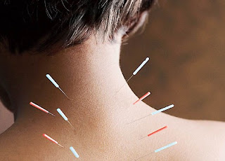 Benefits Acupuncture Treatment for  Cerebral Palsy