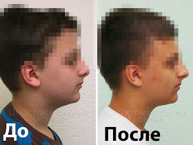 Профиль пациента до и после  лечения брекетами