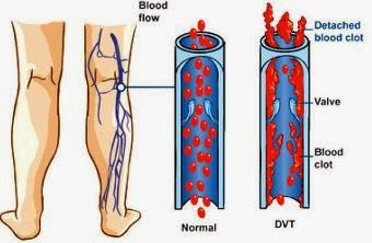 Deep Vein Thrombosis