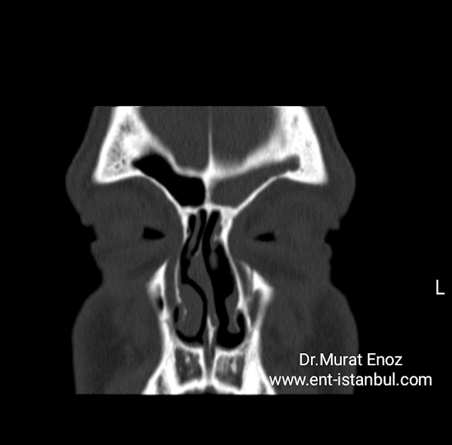 Chronic sinusitis Tomography