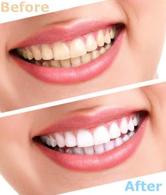 Phương pháp tẩy trắng răng an toàn và hiệu quả