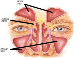 Ubat Penawar Resdung: Apa itu Resdung (Sinus)?