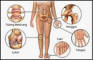 Penyebab Dan Cara Mengatasi Penyakit Asam Urat