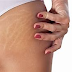 Using Coconut Oil Prevent & Treat Stretch Marks on Your Body!