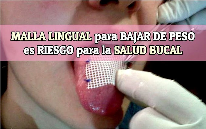 MALLA LINGUAL para bajar de peso es riesgo para la salud bucal