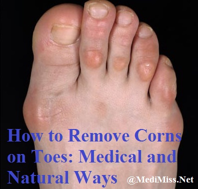 How to Remove Corns on Toes: Medical and Natural Ways ...