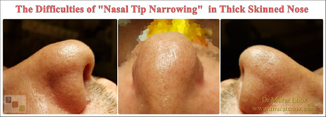 Nasal tip narrowing - Nose Tip Thinning - Shrink of bulbous nose tip - How to make smaller nose tip in thick skin patients? - Reduce to nose tip - How is thick nasal skin? - Thin skin with laser - How to understand a thick skin nose? - How about a thick skinned nose? - Bulbous nose - Thick skinned nose healing process - What does thick skinned nose mean? - Nasal tip narrowing in patients with thick nasal skin - Nose tip aesthetics in patients with thick skin