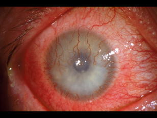 Contact Lens Corneal Neovascularization