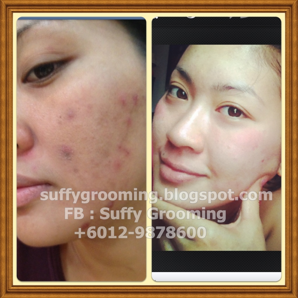 for face pack pimples HONEY MASK TESTIMONIAL WHITENING AND OF TURMERIC : SOAP COLLAGEN for face pack pimples HONEY MASK TESTIMONIAL WHITENING AND OF TURMERIC : SOAP COLLAGEN