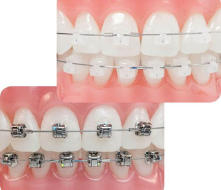 Phương pháp niềng răng hô-1