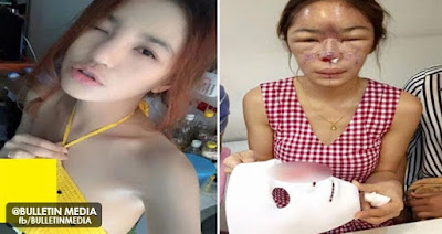 Gara Gara Nak Hidung Mancung, Wajah Model Jelita Jadi Jelek