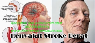 obat stroke herbal,obat herbal stroke,obat stroke denature,obat lumpuh separo,obat stroke ringan,obat stroke berat