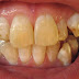 Does tea or coffee stain teeth more?