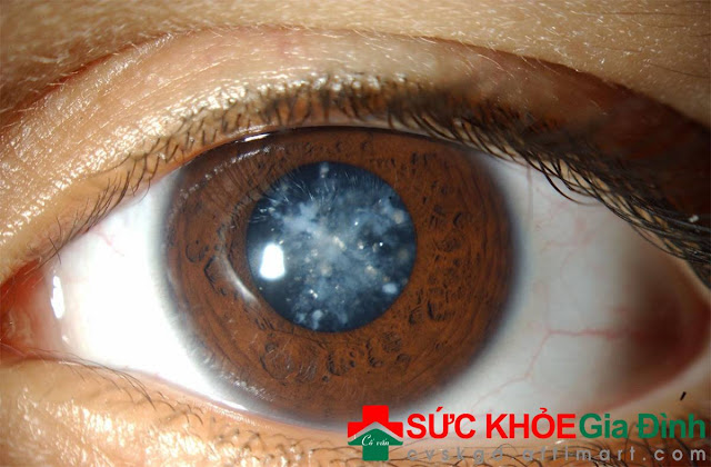 Bệnh đục thủy tinh thể (cataract): Nguyên nhân, triệu chứng, phân loại và cách điều trị tận gốc