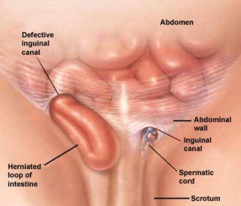 Pengertian Dan Gejala Penyakit Hernia