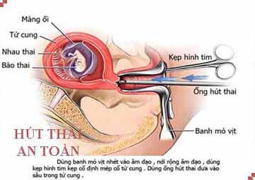 Phương pháp hút thai chết lưu