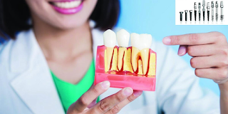 Dental Implant Training In India