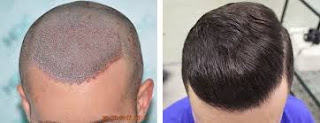 FUE hair transplant Islamabad