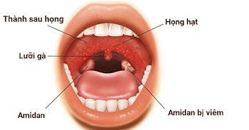 Viêm amidan mãn tính là gì và cách điều trị