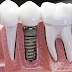 Vì sao cấy ghép implant được ưa chuộng