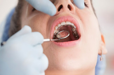 Quy trình niềng răng mặt trong tại nha khoa