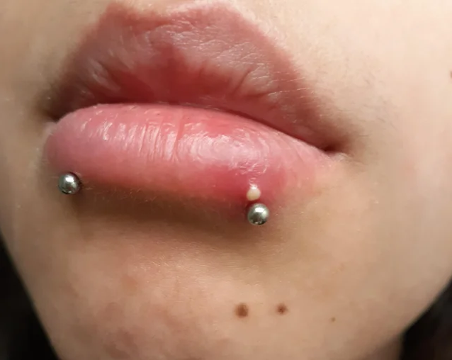 Snake Bite Piercing Infection