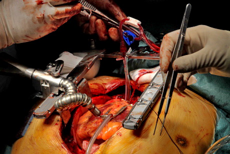 Rawatan Jantung Tersumbat Angioplasty Atau Bypass 