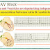 AV block and Its Functionality