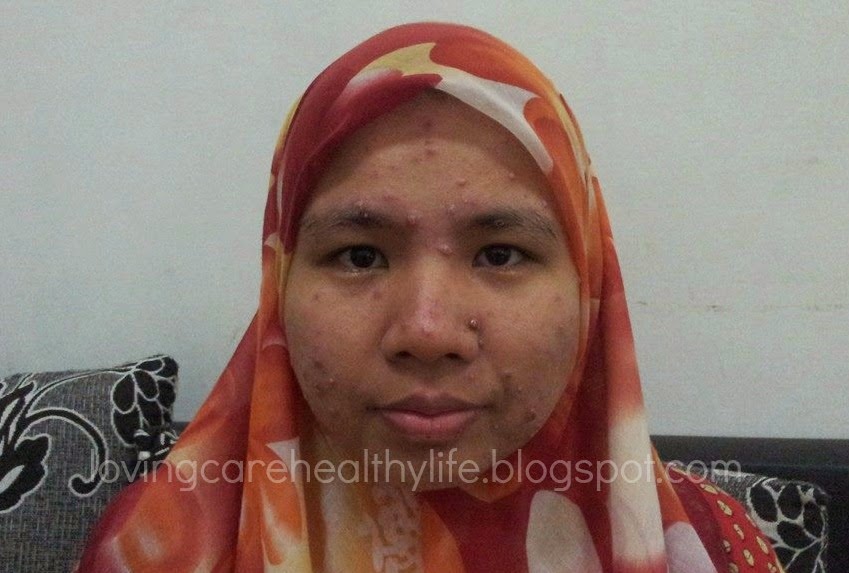 Cara Cepat Hilangkan Parut Chickenpox Supaya Muka Kembali 