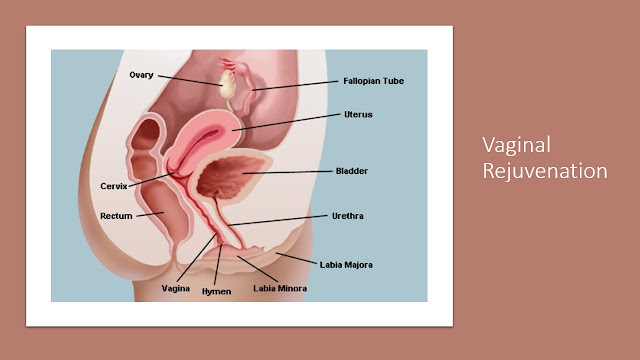 laser vaginal rejuvenation