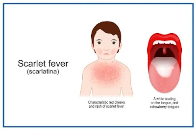 symptoms and causes of scarlet fever, often known as scarlatina