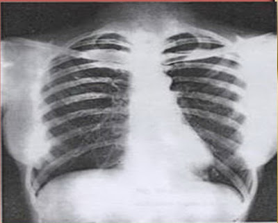 TEKNIK RADIOGRAFI THORAX 