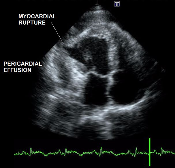 Figure 1: Echocardiographic evaluation showing pseudoaneurysm and rupture of the lateral wall with hemopericardium and intrapericardial thrombus 