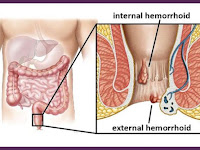 Ciri-Ciri Orang Penyakit Ambeien Atau Wasir