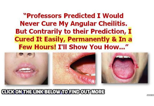 When cracks in the corners of the mouth start to appear, when you have a hard time in opening your mouth because of these cracks and when they start expanding from the corners and affect the skin from all around the lips, you are suffering from Angular Cheilitis. Here are 4 substances you can use for alleviating and treating angular cheilitis.