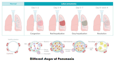 Different stages of Pneumonia