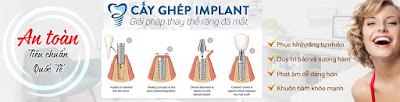 Trồng implant mất thời gian bao lâu ?