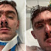 Lille : Adrien, 29 ans, tabassé « pour une montre » par 4 individus, il a reçu de nombreux coups de pied, à la tête, aux côtes, à la nuque… 