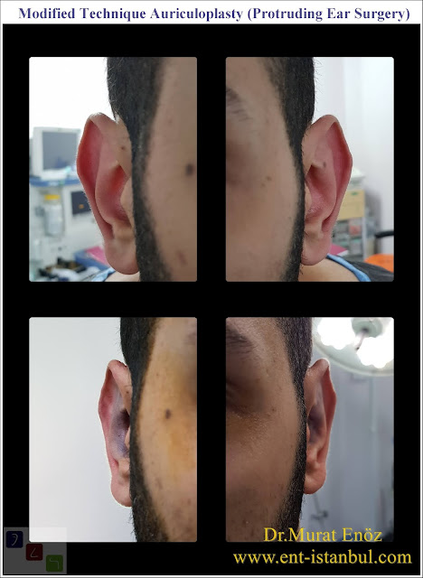 Otoplasty - Pinnaplasty - Auriculoplasty - Cosmetic Ear Surgery - Ear Plastic Surgery - Surgical Correction of Prominent Ears - Protruding Ear Surgery - Ear Reshaping - Ear plastic surgery in Istanbul - Modified technique otoplasty - Modified technique auriculoplasty - Correction of prominent ears in Istanbul  - Treatment of protruding ear - Bat ear - Obtrusive ears - Unfolded ears - Cosmetic ear surgery in Istanbul - Before and after photos for ear plastic surgery in Istanbul, Turkey - Protruding ear surgery - Conchomastoid technique for otoplasty