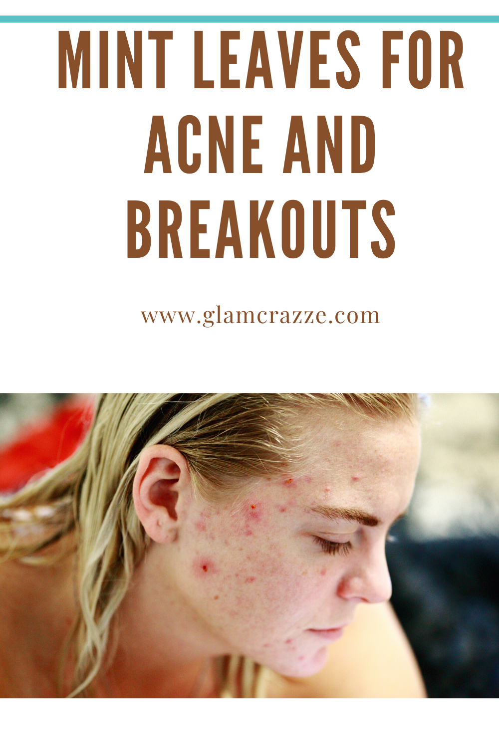 Get rid of acne and achieve clear skin using this home remedies