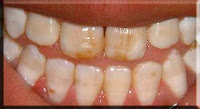 manchas fluorosis dental