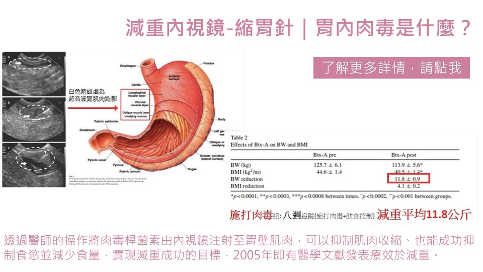 內視鏡減重 縮胃 控制食慾 胃內肉毒 縮胃針