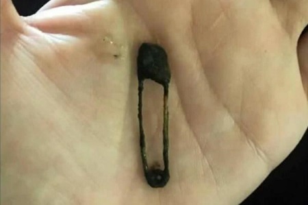 Omg! 5-year-old Girl Blows Safety Pin Out of Her Nose After Being Mysteriously Sick for 6-Months (Photo)