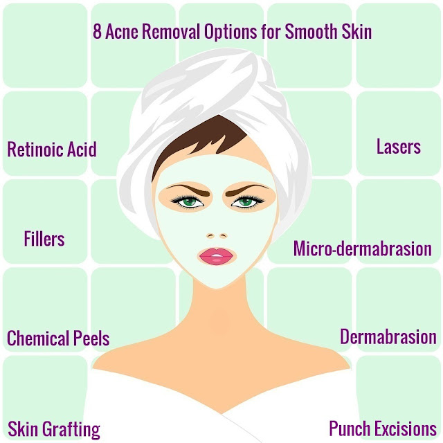 8 Acne Removal Options