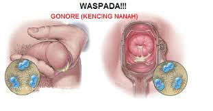 Apa obat kelamin keluar lendir seperti nanah di apotik ampuh