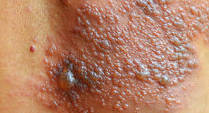 cara menyembuhkan herpes