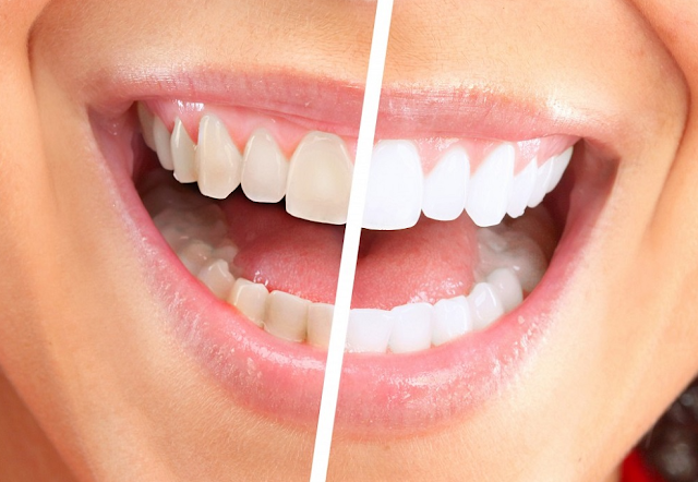 clean teeth