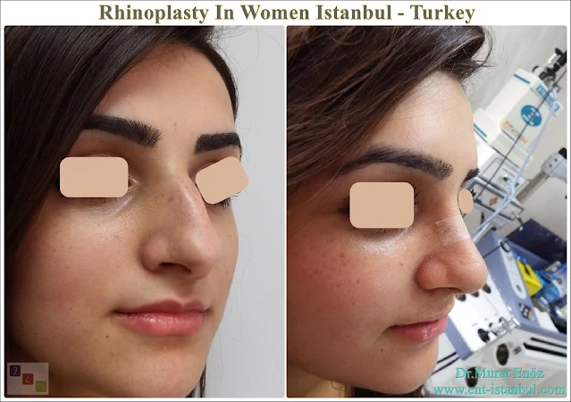 Rhinoplasty In Women Istanbul - Turkey